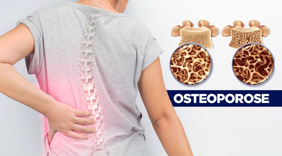 Osteoporose pode virar Câncer