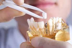 Quem tem HIV pode fazer implantes dentários?