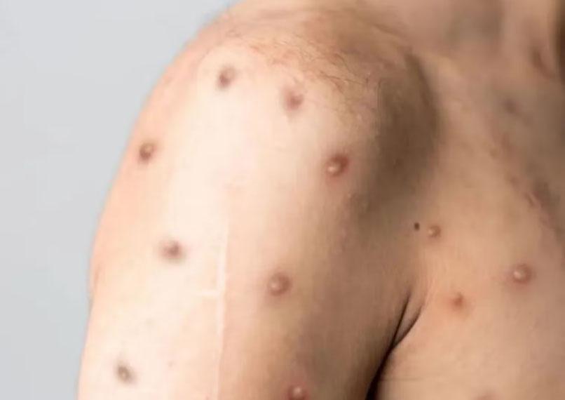 Paraná registra primeiro caso do vírus mpox do ano, diz Secretaria de Saúde